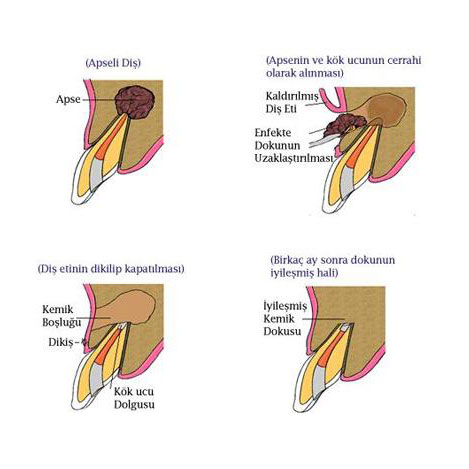 endodontik tedavi
